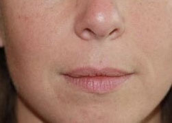 Dermal Laugh Lines - 1