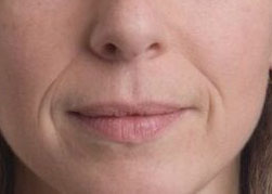 Dermal Laugh Lines - 1