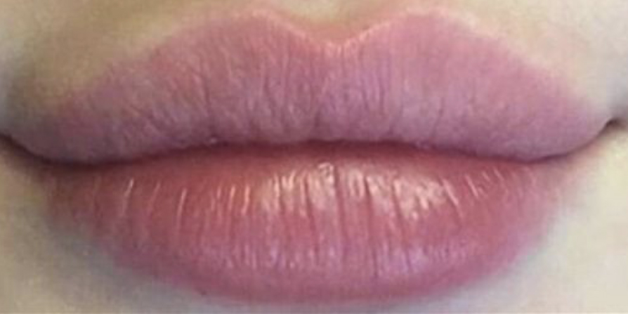 Dermal Filler Lips - 5
