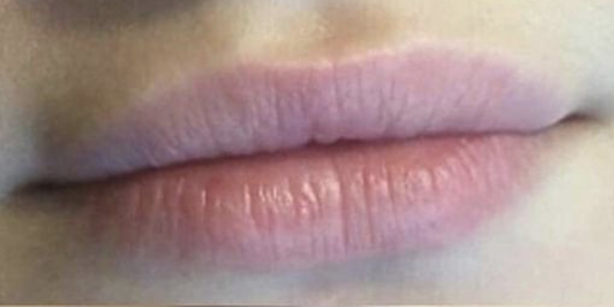 Dermal Filler Lips - 5