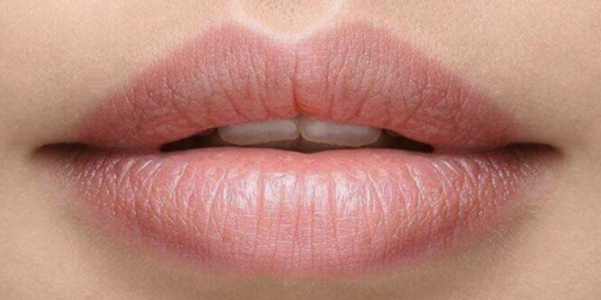 Dermal Filler Lips - 6