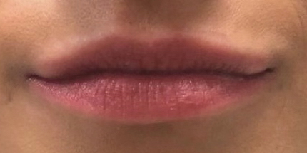 Dermal Filler Lips - 1