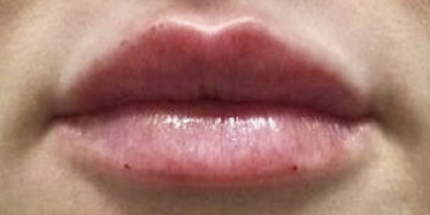 Dermal Filler Lips - 2