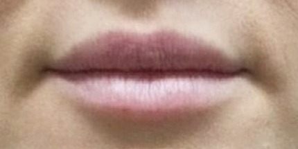 Dermal Filler Lips - 2