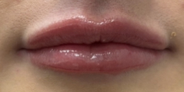Dermal Filler Lips - 3