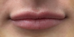 Dermal Filler Lips - 3