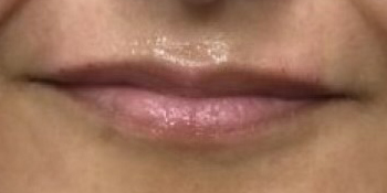 Dermal Filler Lips - 4